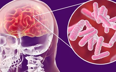 Avanços no Diagnóstico da Neurotuberculose: Aplicação de Novo Algoritmo ao Líquor Cefalorraquidiano​