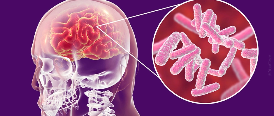 Avanços no Diagnóstico da Neurotuberculose: Aplicação de Novo Algoritmo ao Líquor Cefalorraquidiano​